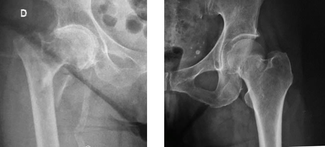 Tratamiento de fracturas de cadera